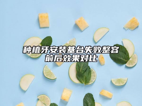 種植牙安裝基臺(tái)失敗整容前后效果對(duì)比