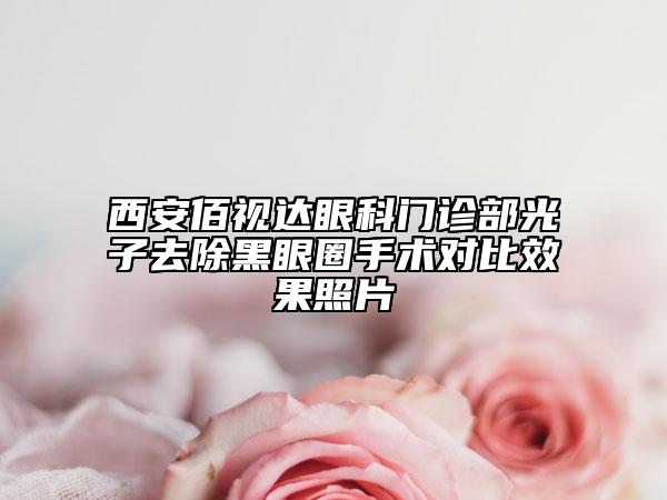 西安佰視達(dá)眼科門診部光子去除黑眼圈手術(shù)對比效果照片